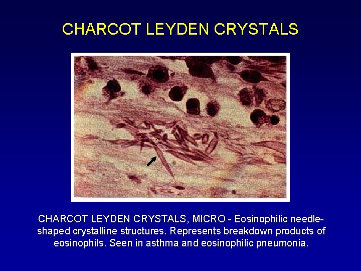 CHARCOT LEYDEN CRYSTALS, MICRO - Eosinophilic needleshaped crystalline structures. Represents breakdown products of eosinophils.