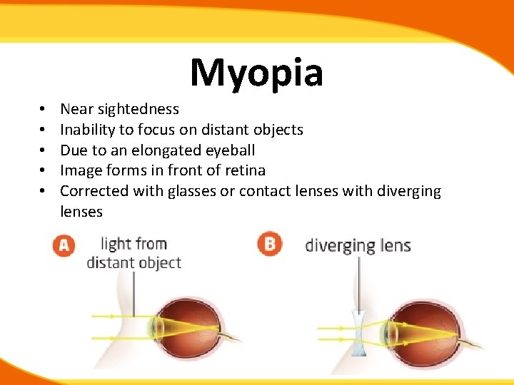 Myopia • • • Near sightedness Inability to focus on distant objects Due to