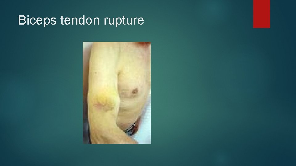 Biceps tendon rupture 