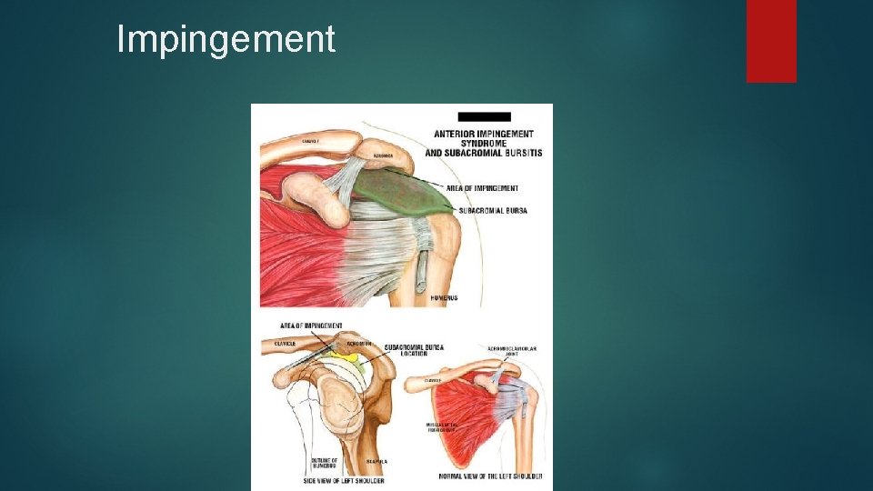 Impingement 