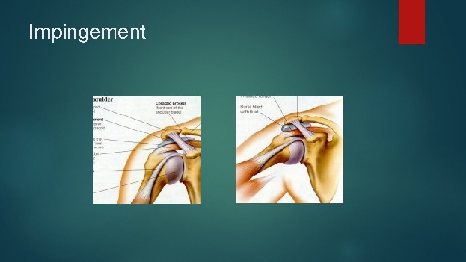 Impingement 