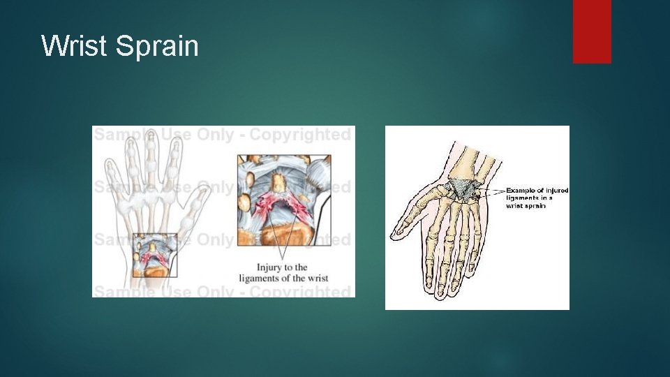 Wrist Sprain 