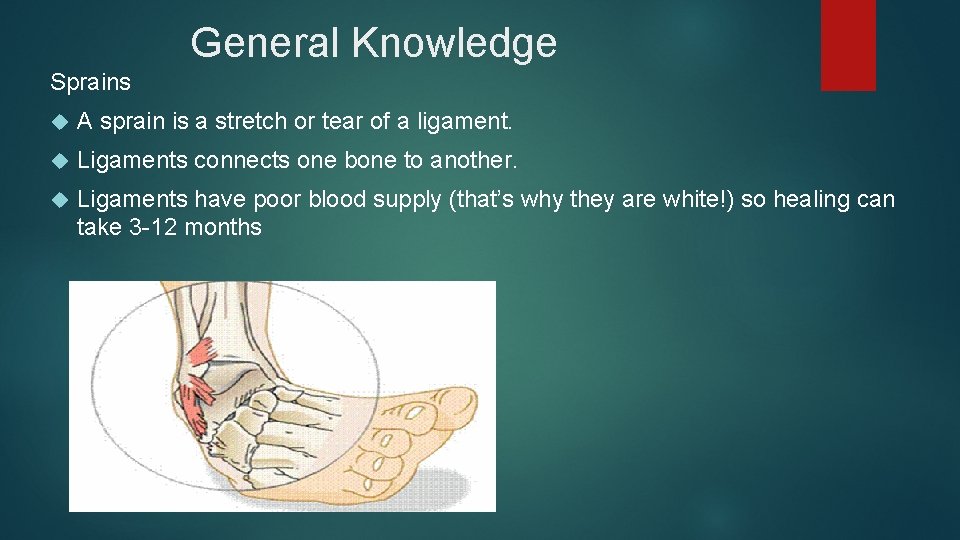 General Knowledge Sprains A sprain is a stretch or tear of a ligament. Ligaments