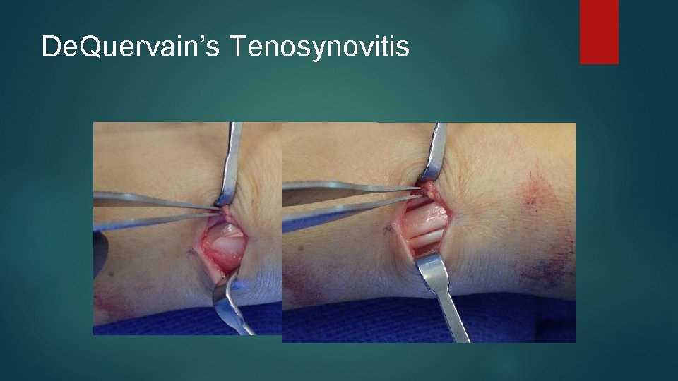 De. Quervain’s Tenosynovitis 