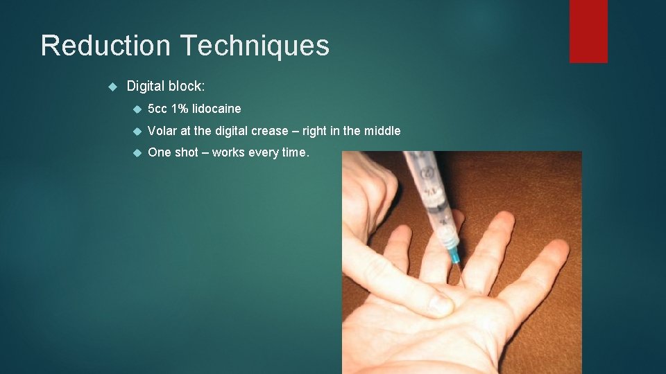 Reduction Techniques Digital block: 5 cc 1% lidocaine Volar at the digital crease –