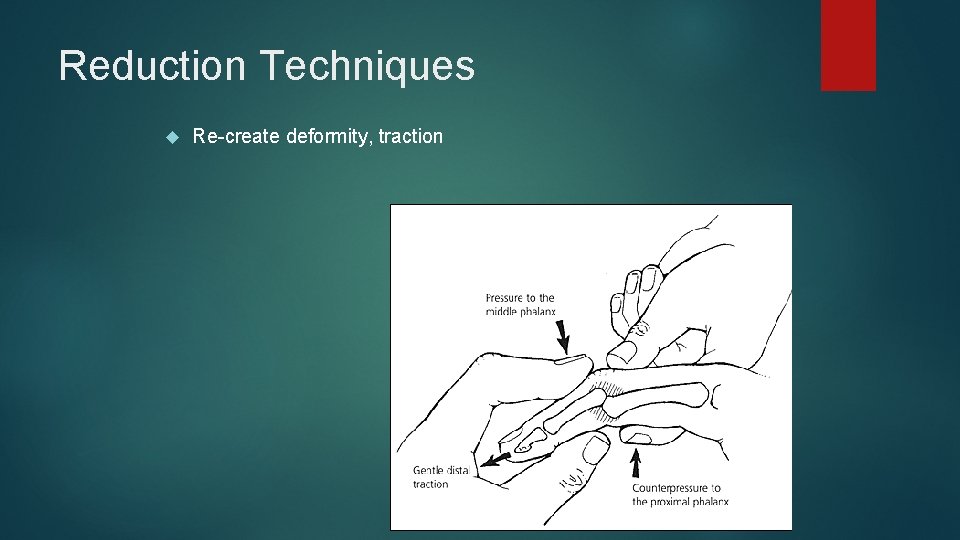 Reduction Techniques Re-create deformity, traction 