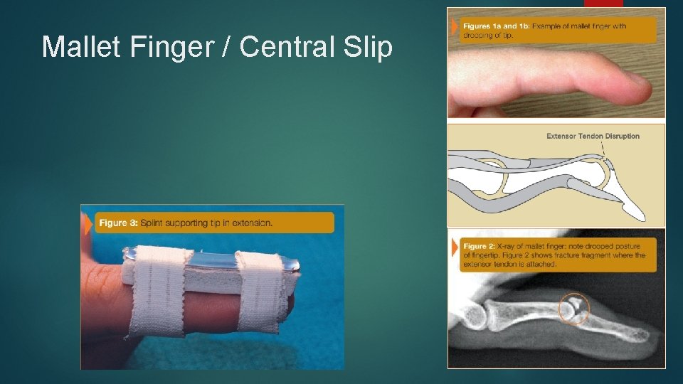 Mallet Finger / Central Slip 