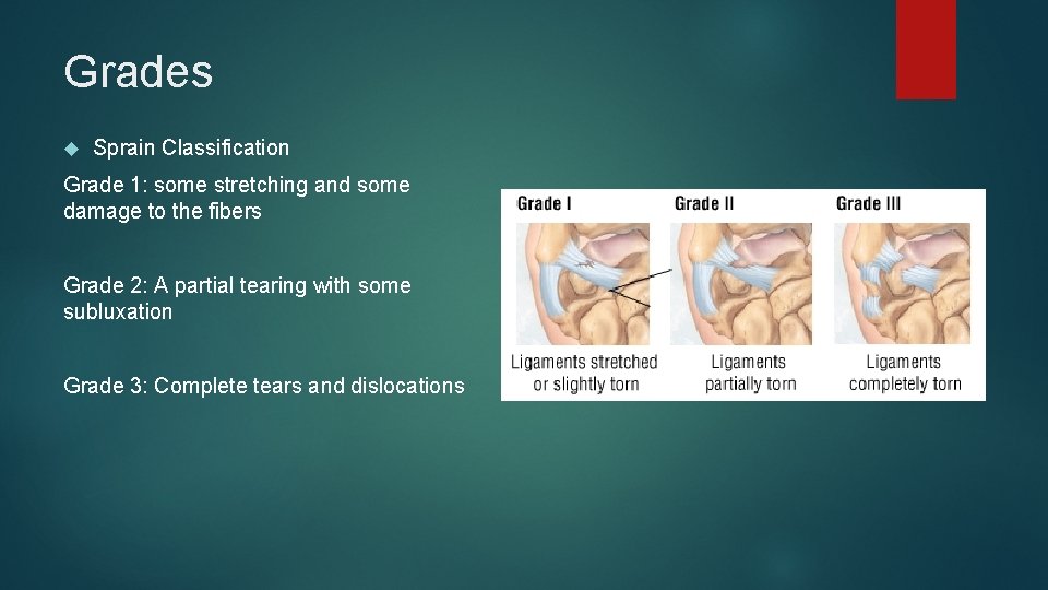 Grades Sprain Classification Grade 1: some stretching and some damage to the fibers Grade