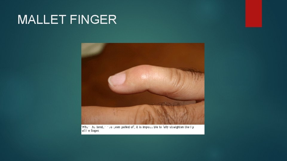 MALLET FINGER 