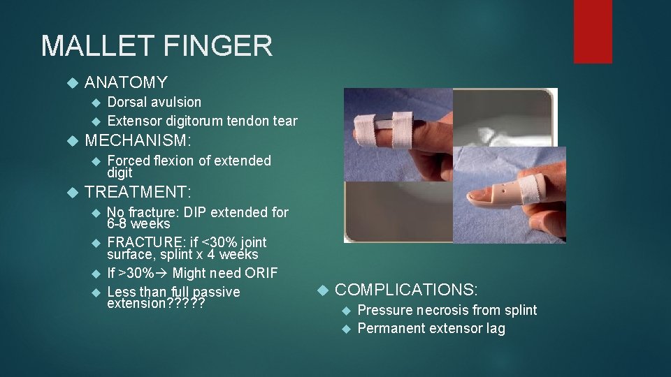 MALLET FINGER ANATOMY Dorsal avulsion Extensor digitorum tendon tear MECHANISM: Forced flexion of extended