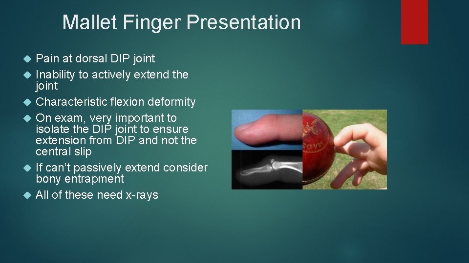 Mallet Finger Presentation Pain at dorsal DIP joint Inability to actively extend the joint