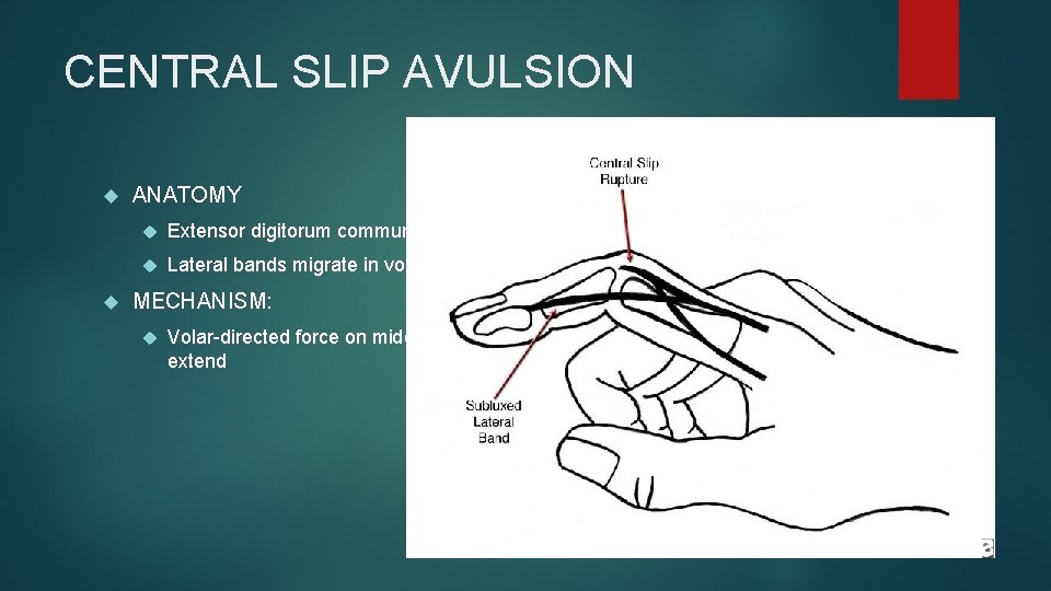 CENTRAL SLIP AVULSION ANATOMY Extensor digitorum communis tendon disruption Lateral bands migrate in volar