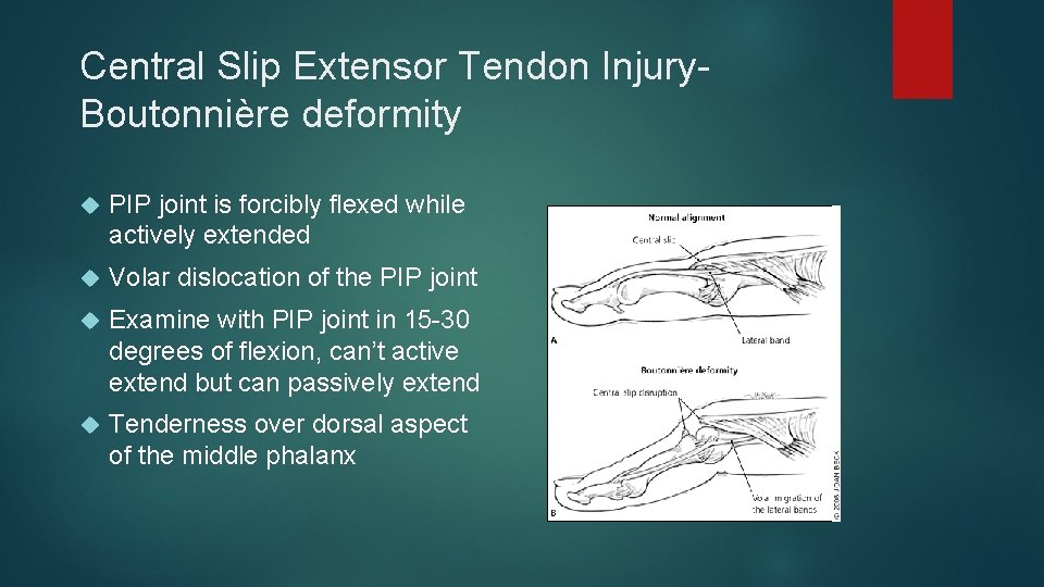 Central Slip Extensor Tendon Injury. Boutonnière deformity PIP joint is forcibly flexed while actively