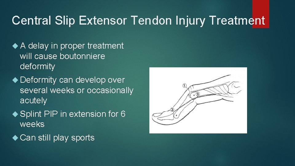 Central Slip Extensor Tendon Injury Treatment A delay in proper treatment will cause boutonniere