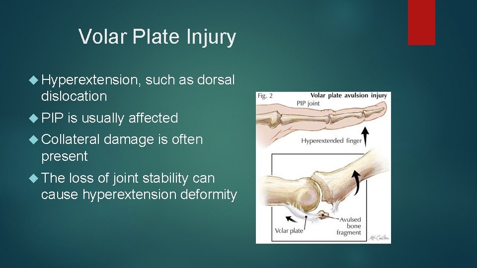 Volar Plate Injury Hyperextension, such as dorsal dislocation PIP is usually affected Collateral damage