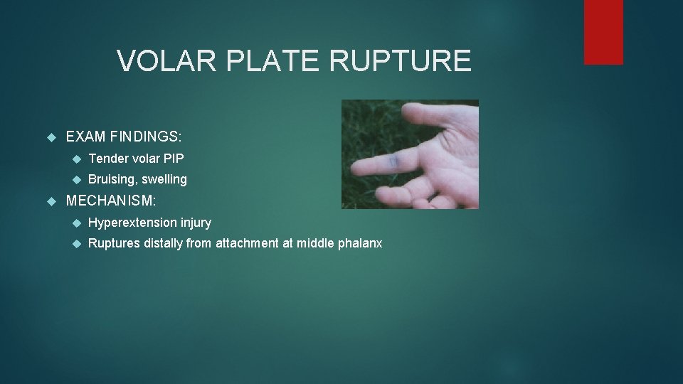 VOLAR PLATE RUPTURE EXAM FINDINGS: Tender volar PIP Bruising, swelling MECHANISM: Hyperextension injury Ruptures