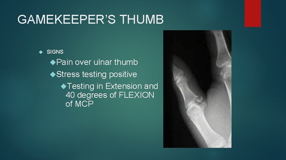 GAMEKEEPER’S THUMB SIGNS Pain over ulnar thumb Stress testing positive Testing in Extension and