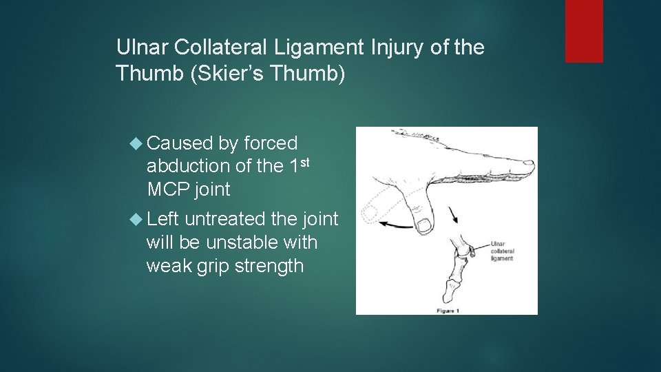 Ulnar Collateral Ligament Injury of the Thumb (Skier’s Thumb) Caused by forced abduction of