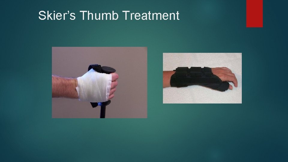 Skier’s Thumb Treatment 