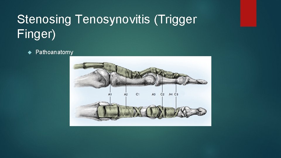 Stenosing Tenosynovitis (Trigger Finger) Pathoanatomy 