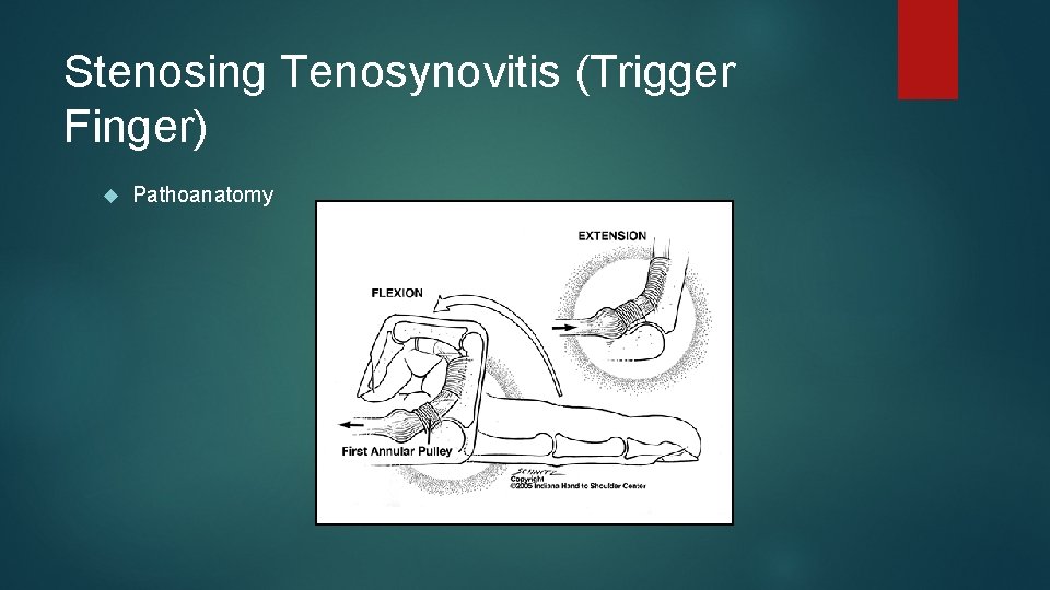 Stenosing Tenosynovitis (Trigger Finger) Pathoanatomy 