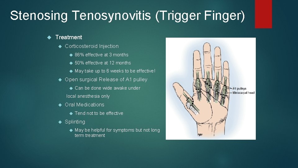 Stenosing Tenosynovitis (Trigger Finger) Treatment Corticosteroid Injection 86% effective at 3 months 50% effective