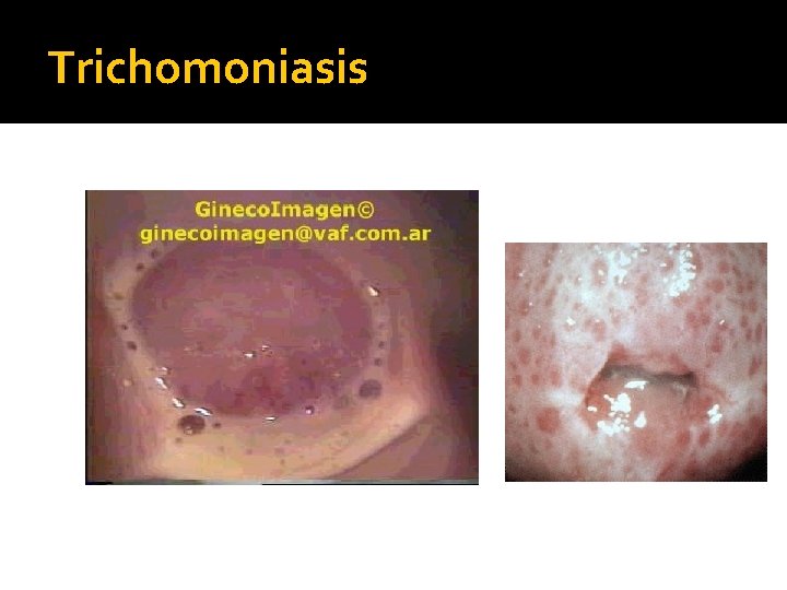 Trichomoniasis Trichomoniasis