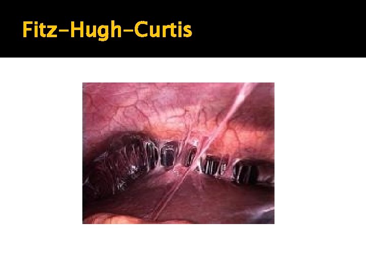 Fitz-Hugh-Curtis Fitz-Hugh-Curtis