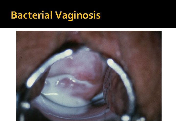 Bacterial Vaginosis Bacterial Vaginosis