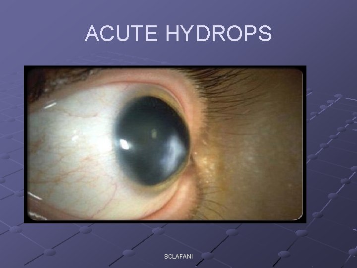 ACUTE HYDROPS SCLAFANI 