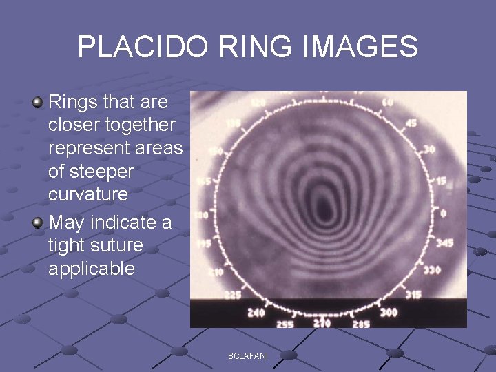 PLACIDO RING IMAGES Rings that are closer together represent areas of steeper curvature May