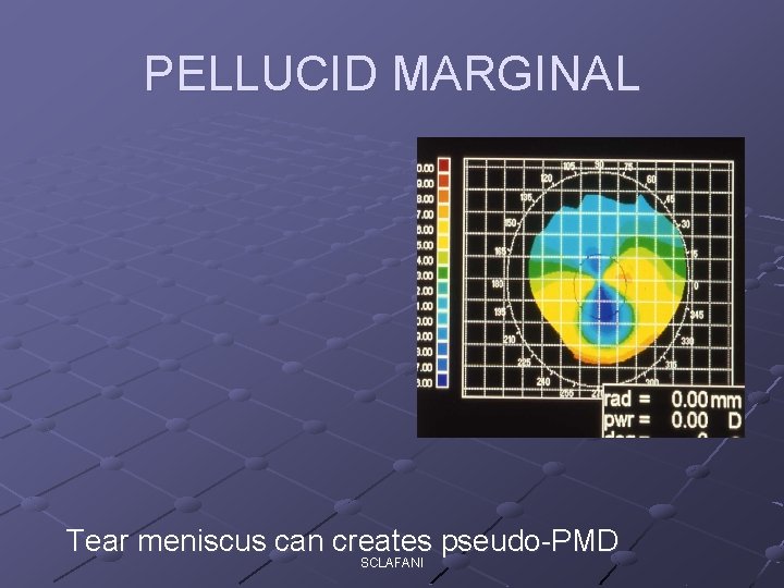 PELLUCID MARGINAL Tear meniscus can creates pseudo-PMD SCLAFANI 