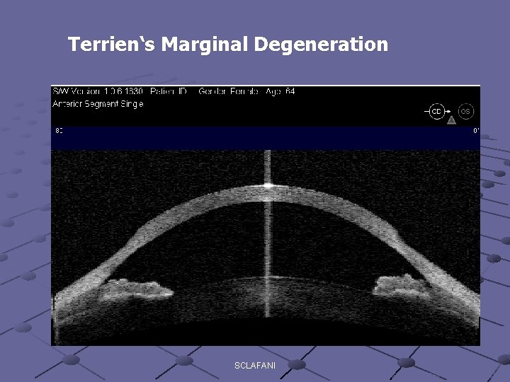 Terrien‘s Marginal Degeneration SCLAFANI image courtesy of Dr. M. Packer 