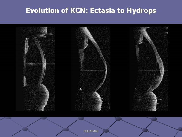 Evolution of KCN: Ectasia to Hydrops SCLAFANI image courtesy of Prof. G. Baikoff 