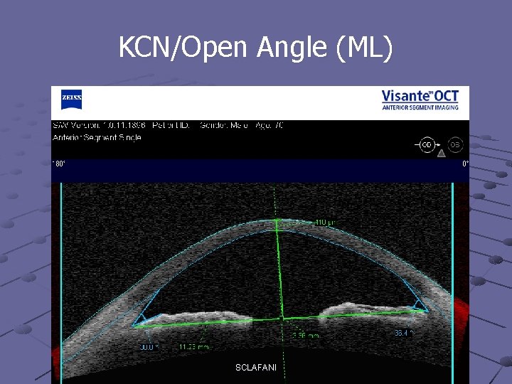 KCN/Open Angle (ML) SCLAFANI 