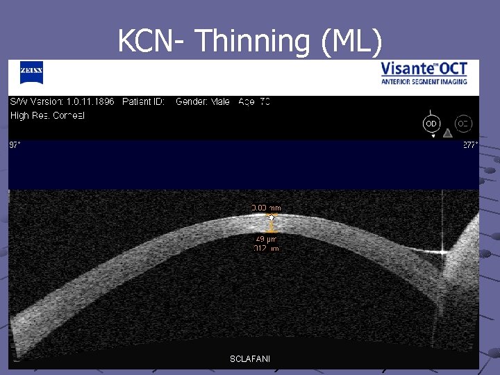 KCN- Thinning (ML) SCLAFANI 