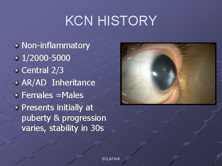 KCN HISTORY Non-inflammatory 1/2000 -5000 Central 2/3 AR/AD Inheritance Females =Males Presents initially at