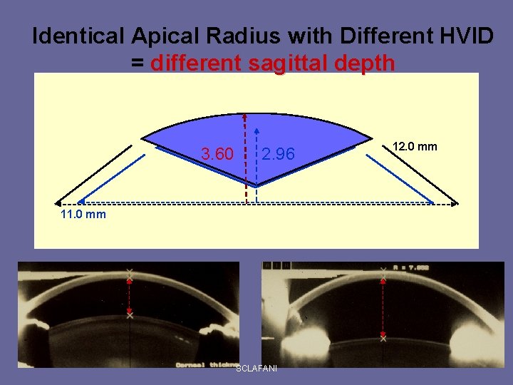 Identical Apical Radius with Different HVID = different sagittal depth 3. 60 2. 96