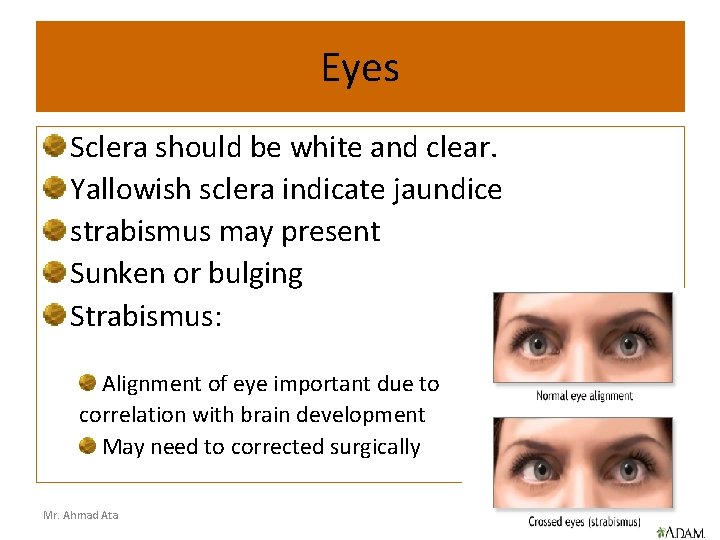 Eyes Sclera should be white and clear. Yallowish sclera indicate jaundice strabismus may present