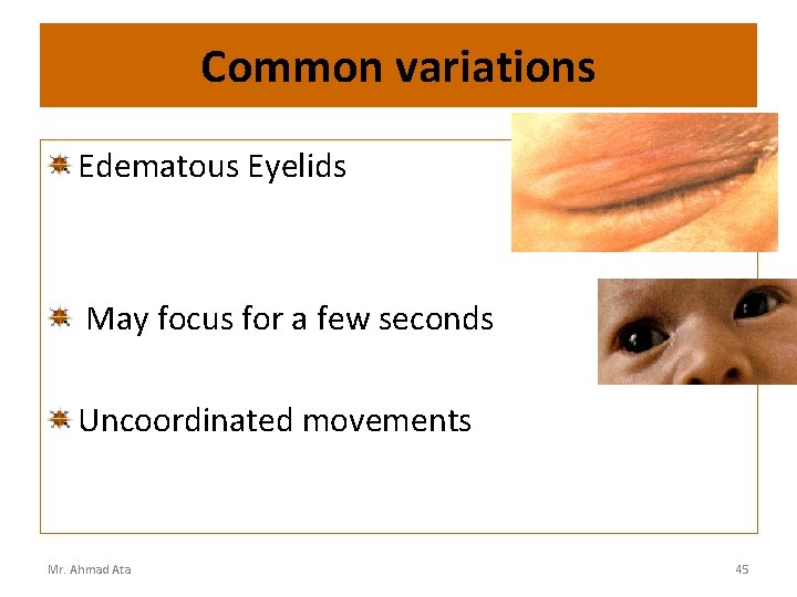 Common variations Edematous Eyelids May focus for a few seconds Uncoordinated movements Mr. Ahmad