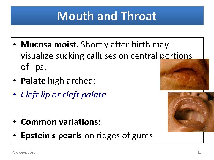 Mouth and Throat • Mucosa moist. Shortly after birth may visualize sucking calluses on