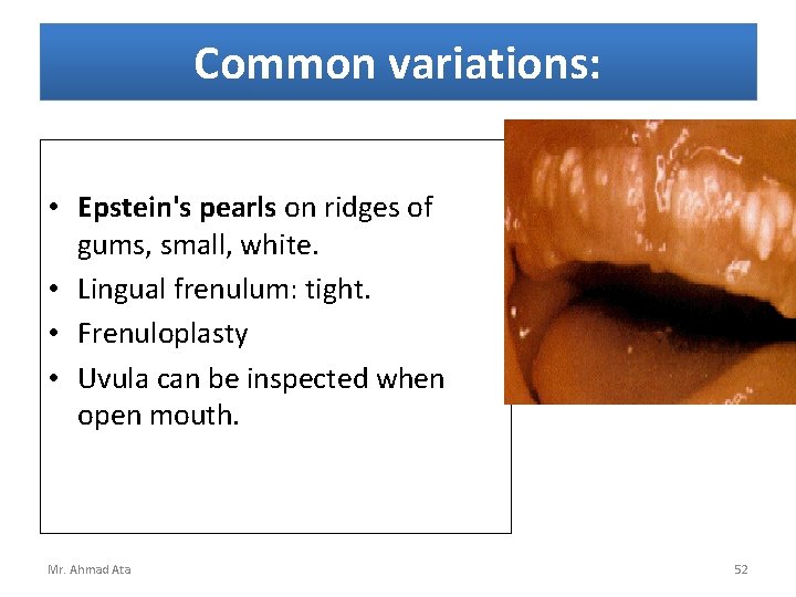 Common variations: • Epstein's pearls on ridges of gums, small, white. • Lingual frenulum: