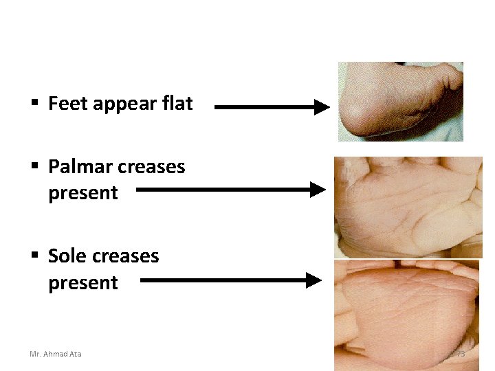  Feet appear flat Palmar creases present Sole creases present Mr. Ahmad Ata 73