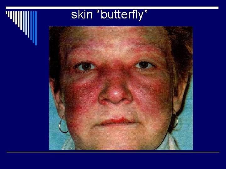 skin “butterfly” 