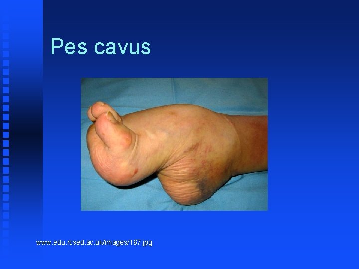 Pes cavus www. edu. rcsed. ac. uk/images/167. jpg 