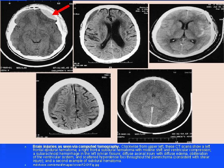 n Brain injuries as seen via computed tomography. Clockwise from upper left, these CT