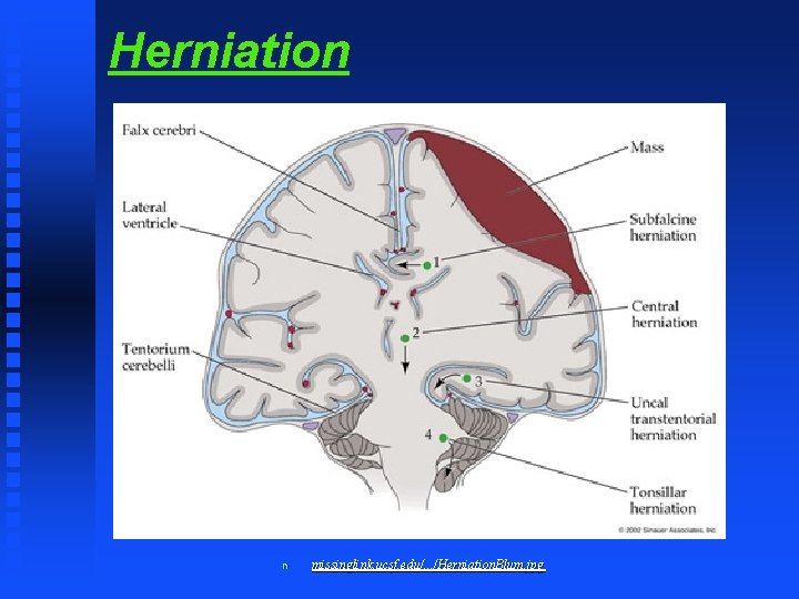 Herniation n missinglink. ucsf. edu/. . . /Herniation. Blum. jpg 