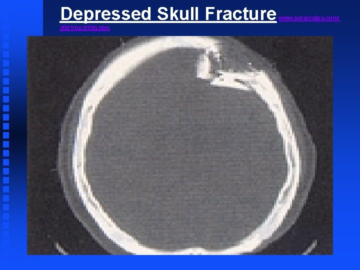 Depressed Skull Fracture 2001/toc 0106. htm www. surgicalpa. com/ 