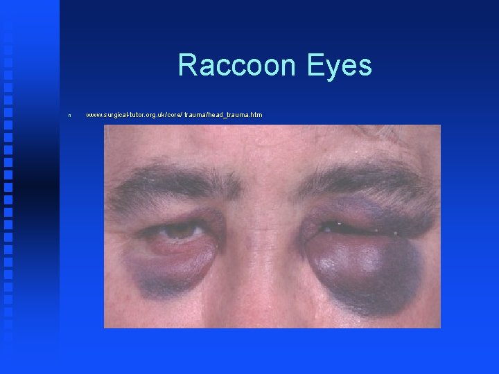 Raccoon Eyes n www. surgical-tutor. org. uk/core/ trauma/head_trauma. htm 