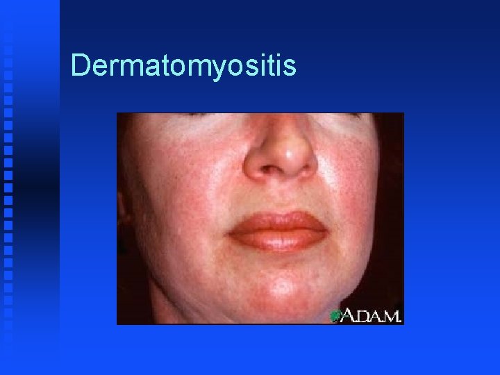 Dermatomyositis 